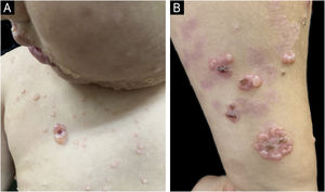 (A) Vesículas com padrão de “colar de pérolas” na face, pescoço e tronco. (B) Lesões agrupadas em aglomerados em forma de roseta no antebraço.