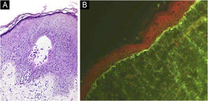 (A) Histopatologia da lesão mostrando clivagem subepidérmica com infiltrado neutrofílico circundando uma papila dérmica (Hematoxilina & eosina, 200×). (B) Imunofluorescência direta revela depósitos lineares e moderados de IgA na zona da membrana basal (200×).