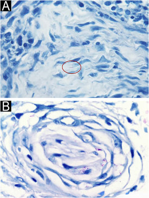 Bacilos álcool‐ácido resistentes em nervos cutâneos. (A) Nervo cutâneo paucibacilar com bacilo álcool‐ácido resistente dentro de uma célula de Schwann (Fite‐Faraco, 100×). (B) Nervo cutâneo multibacilar (seção transversal) mostrando numerosos bacilos álcool‐ácido resistentes dentro de células de Schwann e perineurais. (Fite‐Faraco, 400×).