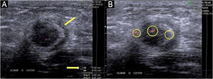 Ultrassonografia do nervo ulnar (plano transversal ao cotovelo). (A) A imagem em modo B revela espessamento acentuado com perímetro de 3,52cm e área de aproximadamente 0,91 cm2 (≈91 mm2); para referência, o normal é de aproximadamente 0,10 cm2 (≈10 mm2). Observe o espessamento epineural e halo hiperecoico em forma de crescente (seta). (B) O Doppler colorido no mesmo nível mostra três focos de fluxo peri/intraneural (círculos 1 a 3) dentro da área Doppler, compatíveis com neurite inflamatória.