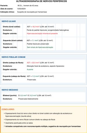 Exemplo de laudo ultrassonográfico em hanseníase. Espessamento focal do nervo ulnar direito no túnel cubital (área de secção transversal [AST] de 18,2 mm2; normal <10 mm2), com perda do padrão fascicular, ecogenicidade heterogênea e aumento do fluxo intraneural ao Doppler colorido – achados indicativos de neurite ativa. Observa‐se também espessamento do nervo fibular comum direito (AST de 22,5 mm2) com alteração ecotextural focal. A comparação com o lado contralateral revela assimetria acentuada. Esses achados são compatíveis com padrão de mononeuropatia múltipla assimétrica associada à hanseníase.