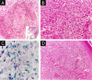Espectro histopatológico da hanseníase. (A) Hanseníase tuberculoide: granulomas epitelioides bem formados com halo linfocítico periférico acompanhando os feixes neurovasculares na derme e estendendo‐se até o tecido subcutâneo (Hematoxilina & eosina, 200×; detalhe 40×). (B) Hanseníase virchowiana: infiltrado confluente de macrófagos com abundante citoplasma vacuolizado (“espumoso”; Hematoxilina & eosina, 400×). (C) Hanseníase virchowiana: a coloração de Fite‐Faraco destaca numerosos bacilos no citoplasma dos macrófagos (1000×). (D) Hanseníase virchowiana: epiderme achatada separada de infiltrado rico em macrófagos por faixa subepidérmica de colágeno (“zona de grenz”; Hematoxilina & eosina, 100×).