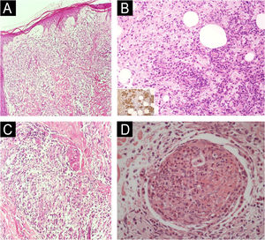 Reações da hanseníase: tipo 1 vs. tipo 2. (A) Reação tipo 1: edema dérmico separando os componentes do infiltrado inflamatório (Hematoxilina & eosina, 40×). (B) Reação tipo 1: granuloma epitelioide com dissociação de células inflamatórias relacionada ao edema (Hematoxilina & eosina, 100×). (C) Reação tipo 2: exsudação rica em neutrófilos dentro de um lóbulo de gordura subcutânea em fundo rico em macrófagos; detalhe: imuno‐histoquímica anti‐BCG destaca o antígeno micobacteriano no citoplasma do macrófago (Hematoxilina & eosina para o painel principal, 200×; detalhe 200×). (D) Reação tipo 2: nervo subcutâneo permeado por exsudato neutrofílico (Hematoxilina & eosina, 200×).