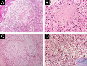 Diagnóstico diferencial das dermatoses granulomatosas. (A) Tuberculose cutânea: granulomas epitelioides, por vezes confluentes, ocupando a derme reticular (Hematoxilina & eosina, 100×). (B) Tuberculose cutânea: necrose fibrinoide dentro dos granulomas (Hematoxilina & eosina, 200×). (C) Sarcoidose: granulomas epitelioides compactos (“nus”) com mínima inflamação periférica (Hematoxilina & eosina, 200×). (D) Granuloma anular: histiócitos em paliçada circundando focos de colágeno alterado; detalhe: azul de Alcian destaca a mucina em áreas de degeneração do colágeno (Hematoxilina & eosina para o painel principal, 200×; detalhe 200×).