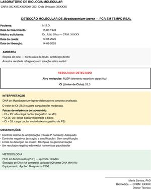 Exemplo de laudo de PCR quantitativa em tempo real para Mycobacterium leprae (alvo RLEP) de biopsia da borda ativa de uma lesão, mostrando resultado positivo. (Ct 28.3). O Ct é inversamente proporcional à carga bacilar; neste laboratório, valores <25 indicam alta carga (formas multibacilares), 25 a 35 carga moderada e >35 baixa carga (formas paucibacilares). Controles internos e negativos válidos confirmam a qualidade do ensaio.