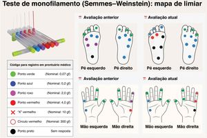 Teste com monofilamento de Semmes‐Weinstein: mapeamento bilateral dos limiares táteis nas mãos e nos pés. Cada ponto registra o menor filamento percebido no local testado; as cores seguem a legenda apresentada. A comparação entre a “avaliação anterior” e a “avaliação atual” propicia o reconhecimento de piora clinicamente significante – a necessidade de filamentos mais espessos em ≥ 2 pontos dentro do mesmo território, ou o surgimento de áreas não responsivas –, consistente com neurite progressiva nos nervos ulnar direito e tibial posterior esquerdo.
