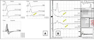 Achados eletrodiagnósticos na neuropatia desmielinizante. (A) Condução motora ulnar bilateral. Esquerda: Nervo ulnar direito normal. Direita: Nervo ulnar esquerdo com bloqueio de condução parcial (redução do PAMC >50% acima do cotovelo, seta amarela). (B) Nervo tibial direito no tornozelo. A1/B1: Nervo plantar medial; C1/D1: Nervo plantar lateral. Dispersão temporal progressiva evidente em B1/D1 (setas vermelhas). Velocidades reduzidas no túnel do tarso (19,3–19,0 m/s, circulado). Bloqueio de condução e dispersão temporal caracterizam a desmielinização segmentar.