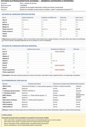 Exemplo de laudo eletrodiagnóstico em hanseníase. Nervo ulnar com velocidade de condução motora reduzida (35 m/s; normal >50 m/s) e ausência de resposta sensorial; nervo fibular comum com bloqueio parcial de condução na cabeça da fíbula; nervos mediano e tibial preservados. Padrão compatível com mononeuropatia múltipla assimétrica.