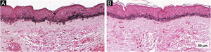 Imagens de Fontana‐Masson do grupo AT evidenciando redução da melanina epidérmica. (A) Linha basal. (B) Pós‐tratamento (Fontana‐Masson, 40×).