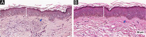 Imagens de Hematoxilina & eosina do grupo AT/CET: antes (A) e depois (B). As barras indicam o aumento da espessura da epiderme; as setas mostram a redução da elastose solar (Hematoxilina & eosina, 40×).