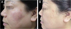 (A) Placa edematosa eritematosa mal delimitada na região bucinadora esquerda. (B) Resolução clínica completa alcançada após três meses de monoterapia com tofacitinibe.