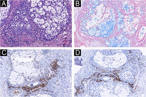 (A) Deposição maciça de mucina no epitélio folicular (Hematoxilina & eosina, 40×). (B) Deposição de mucina confirmada pela coloração com azul de Alcian (200×). A análise imuno‐histoquímica demonstrou que os linfócitos eram positivos para CD4 (C) e CD8 (D), com proporção CD4+/CD8+equilibrada (100×).