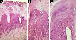 Exame histopatológico da região plantar. A: Acantose, hiperceratose (h), alongamento (a) das cristas epiteliais (Hematoxilina & eosina, 100×). B: Proliferação de capilares (c) papilares, infiltrado inflamatório (i), paraceratose (p), hipogranulose, microabscesso intraepidérmico (m), espongiose (e) discreta (Hematoxilina & eosina, 200×). C: Hipogranulose (g), com presença de neutrófilos (n) intraepidérmicos e subcórneos (Hematoxilina & eosina, 400×).