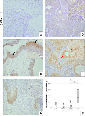 Imuno‐histoquímica para EPPK1 em amostras de pele. (A) Controle negativo. (B) Pele normal, expressão citoplasmática intensa de EPPK1 no estrato granuloso (seta preta) e leve no estrato espinhoso. (C) Nevo intradérmico, expressão citoplasmática muito baixa de EPPK1. (D) Carcinoma basocelular, expressão citoplasmática moderada de EPPK1. (E) Carcinoma de células escamosas, forte expressão citoplasmática de EPPK1, especialmente nas células ao redor das pérolas de queratina (seta vermelha). Barras de escala: A, inserções de 30μm, B–E 100μm. (F) Diagrama de caixa mostrando a densidade óptica de EPPK1 como mediana±IIQ; as linhas indicam mínimo‐máximo. Teste de Kruskal‐Wallis, *p <0,05; a, significantemente diferente da pele normal e do CCE; CBC, carcinoma basocelular; CCE, carcinoma de células escamosas; IIQ, intervalo interquartil.