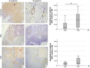 Imuno‐histoquímica para detecção de E‐caderina e N‐caderina em amostras de pele. (A) Pele normal: E‐caderina predominantemente nas junções intercelulares com menor expressão citoplasmática. (B) CBC: expressão citoplasmática de E‐caderina. (C) CCE: expressão citoplasmática de E‐caderina, com aumento da intensidade em algumas células. (D) Pele normal: intensa expressão de N‐caderina nas paredes vasculares. (E) CBC, expressão citoplasmática de N‐caderina. (F) CCE, baixa expressão de N‐caderina. Barras de escala: A, D, inserções 30μm; B, C, E, F 100μm. (G) Diagrama de caixa da densidade óptica de E‐caderina (mediana±IIQ), CCE significantemente maior que CBC. (H) Diagrama de caixa da densidade óptica de N‐caderina (mediana±IIQ). As linhas indicam mínimo – máximo. Teste de Kruskal‐Wallis, *p <0,05. CBC, carcinoma basocelular; CCE, carcinoma de células escamosas; IIQ, intervalo interquartil.