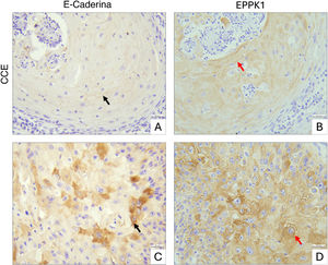 Imuno‐histoquímica de E‐caderina e EPPK1 em CCE. (A‐B) CCE bem diferenciado, com E‐caderina predominantemente nas junções intercelulares (seta preta) e região correspondente mostrando intensa expressão citoplasmática de EPPK1 (seta vermelha). (C‐D) Outra área do mesmo tumor de CCE, mostrando aumento regional de E‐caderina citoplasmática em algumas células tumorais (seta preta) e regulação positiva citoplasmática generalizada de EPPK1 na mesma região (seta vermelha). Barras de escala: 30μm.