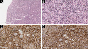 Achados histopatológicos e imuno‐histoquímicos. (A) Epitélio escamoso estratificado com erosão superficial e espongiose (Hematoxilina & eosina, 100×). (B) Infiltrado denso de plasmócitos subepiteliais com núcleos excêntricos e citoplasma basofílico (Hematoxilina & eosina, 400×). (C) Coloração citoplasmática positiva para cadeias leves kappa em plasmócitos (imunomarcação, ampliação digital equivalente a 400×). (D) Coloração citoplasmática positiva para cadeias leves lambda, confirmando policlonalidade (imunomarcação, ampliação digital equivalente a 400×).