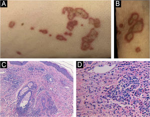 (A) Placas anulares eritemato‐violáceas com clareamento central na coxa. (B) Placas anulares bem delimitadas no membro superior. (C) Infiltrado dérmico denso perivascular e intersticial rico em eosinófilos com edema e extravasamento de eritrócitos (Hematoxilina & eosina, 100×). (D) Infiltrado rico em eosinófilos sem vasculite ou figuras em chama (Hematoxilina & eosina, 400×).