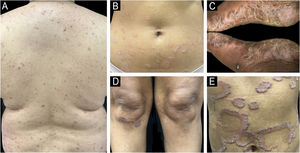 Variabilidade clínica da psoríase em diferentes fototipos de pele. (A) Psoríase em pequenas placas em paciente com fototipo III – variante mais frequentemente observada em populações asiáticas, caracterizada por numerosas pequenas lesões em vez das grandes placas clássicas. (B) Psoríase em placas clássica em paciente com fototipo de pele III, mostrando placas eritematosas bem delimitadas com escamas branco-prateadas. (C) Psoríase palmoplantar em paciente com fototipo de pele VI. Hiperceratose acentuada e descamação amarelada nas solas dos pés podem mimetizar eczema crônico ou tinha. (D) Psoríase em paciente com fototipo de pele V. Pápulas e placas violáceas com descamação acinzentada são observadas em superfícies extensoras típicas. (E) Psoríase anular em paciente com fototipo de pele IV, com placas arqueadas e serpiginosas bem definidas exibindo clareamento central.