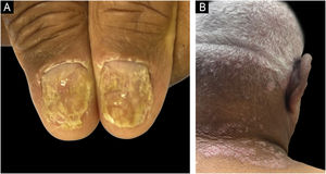 Manifestações de psoríase em áreas de difícil tratamento. (A) Envolvimento das unhas em paciente com fototipo VI de Fitzpatrick, mostrando hiperceratose subungueal, onicólise e sinal da gota de óleo. (B) Envolvimento do couro cabeludo no mesmo paciente, região comumente afetada em pacientes com pele de cor e frequentemente associada a maior carga da doença.