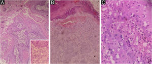 Características histopatológicas das lesões tumorais. Biopsias de pele coradas com hematoxilina & eosina. (A) Epitélio exulcerado com estrato córneo laminar compacto e debris celulares; lâminas e cordões infiltrativos de queratinócitos atípicos formando pérolas de queratina, com núcleos hipercromáticos, mitoses e infiltrado linfocítico (Hematoxilina & eosina, 10×). Capilares dilatados com extravasamento de eritrócitos. Achados compatíveis com carcinoma de células escamosas infiltrativo, ulcerado e bem diferenciado (Hematoxilina & eosina, 50×). (B) Epitélio ulcerado com crosta sero‐hemática, debris e colônias bacterianas, cordões anastomosados de células escamosas pleomórficas e hipercromáticas com mitoses atípicas e citoplasma eosinofílico, infiltrado linfocítico e hemorragia. Compatível com carcinoma de células escamosas infiltrativo ulcerado (Hematoxilina & eosina, 10×). (C) Proliferação escamosa atípica com pleomorfismo e mitoses anormais; derme papilar mostrando extravasamento de eritrócitos e hemossiderina. Consistente com carcinoma de células escamosas infiltrativo (Hematoxilina & eosina, 50×).