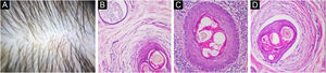 Esta figura apresenta quadro clínico e fotomicrografias de pacientes do grupo com alopecia androgênica. (A) Visão tricoscópica do Paciente 58 mostrando variabilidade no diâmetro da haste capilar. (B) Corte histológico transversal correspondente do Paciente 58 mostrando fibrose perifolicular, infiltrado linfocítico e espongiose no epitélio folicular com exocitose de linfócitos; uma glândula écrina dilatada é visível no canto superior esquerdo (Hematoxilina & eosina, 20×). (C) Inflamação linfocítica grave ao redor de um folículo piloso com leve espongiose epitelial no Paciente 15 (Hematoxilina & eosina, 20×). (D) Fibrose perifolicular proeminente, adelgaçamento epitelial e infiltração linfocítica na derme adjacente no Paciente 28 (Hematoxilina & eosina, 20×).