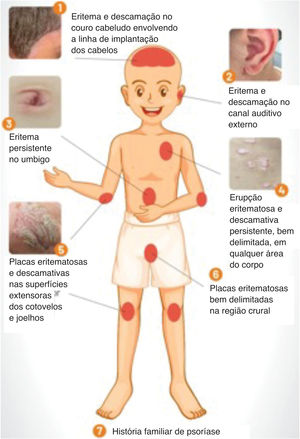 Critérios diagnósticos para psoríase pediátrica adotados por Burden‐Teh et al., 2022.21.