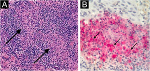 Esporotricose. Caso 1. A, Células histiocitoides agrupadas (setas). B, Células histiocitoides CD163–MPO+. Hematoxilina & eosina, 200×; imunomarcação dupla, 400×.