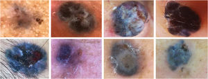 Carcinomas basocelulares difusamente pigmentados – lesões com pigmentação extensa que mascara as características dermatoscópicas clássicas.