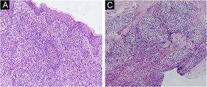 (A) Infiltração de células linfoides na epiderme e folículos pilosos. (B) Infiltração difusa por linfócitos e células de aspecto epitelioide em toda a derme (Hematoxilina & eosina, 200×).