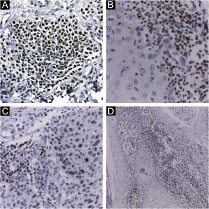 Imuno‐histoquímica utilizando anticorpo monoclonal CM2B4 para detecção de LT‐Ag do poliomavírus de células de Merkel. (A) Marcação nuclear forte (++) em carcinoma de células de Merkel utilizado como controle positivo. (B e D) Marcação nuclear forte (++) em células do infiltrado linfocitário peritumoral de CECc. (C) Marcação nuclear forte (++) em célula de carcinoma espinocelular cutâneo e células do infiltrado linfocitário peritumoral. (Ampliação da imagem: [A, B e C] 400×, [D] 100×).