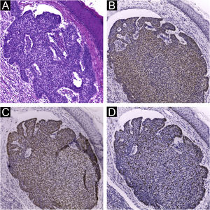 Marcadores imuno‐histoquímicos em carcinoma basocelular nodular. (A) Coloração pela Hematoxilina & eosina. A expressão de p16 (B), p53 (C) e ki67 (D) é nuclear, difusa e forte (++), marcando mais de 50% das células tumorais (ampliação da imagem: 100×).