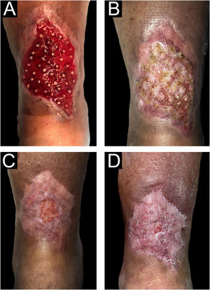 Sequência do processo de cicatrização após enxerto de unidade folicular na perna. Datas das consultas médicas: 10/06/2021 (A), 15/07/2021 (B), 17/10/2021 (C), 11/11/2021 (D).