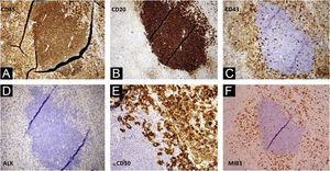 (A–F) Histopatologia com marcação imuno‐histoquímica do linfonodo axilar direito: CD45+ CD30+, CD43+, Bcl‐2+, MUM‐1+, MIB‐1+(60%), CD3−, CD20−, CD79a−, CD10−, BCL6−, CD38−, LMP1−, ALK−, sugestiva de linfoma anaplásico de grandes células.