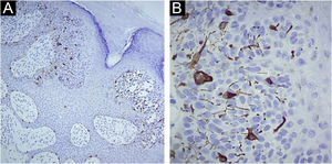 (A) Imuno‐histoquímica com Melan‐A: positivo em esparsos melanócitos dendríticos de permeio às células epiteliais atípicas do siringofibroadenocarcinoma écrino (100×). (B) Imuno‐histoquímica com Melan‐A: positivo em esparsos melanócitos dendríticos entre as células epiteliais atípicas do siringofibroadenocarcinoma écrino (400×).