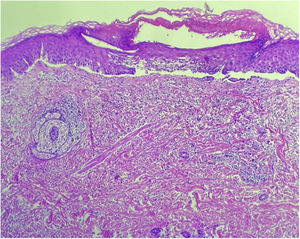 Histopatologia revelando formação de bolhas subepidérmicas com infiltrado inflamatório contendo (Hematoxilina & eosina, 100×).