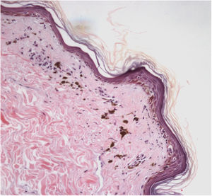 Exame anatomopatológico em Hematoxilina & eosina (aumento de 40×): lesão de líquen plano pigmentoso demonstrando dermatite de interface liquenoide e incontinência pigmentar.