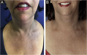 (A) Líquen plano pigmentoso em colo de paciente com alopecia fibrosante frontal antes do tratamento com laser Nd:YAG Q‐Switched. (B) Paciente após o tratamento com laser realizado por Dra. Susana Wu.