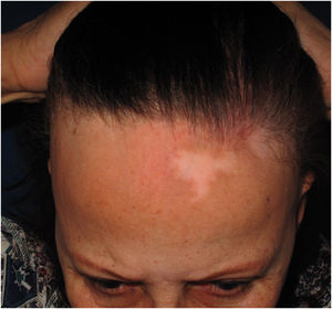 Máculas acrômicas na região da linha de implantação capilar em paciente com diagnóstico de alopecia fibrosante frontal.