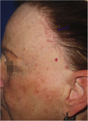 Mácula hipocrômica mal delimitada na região da linha de implantação capilar em paciente com alopecia fibrosante frontal.