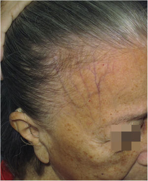 Atrofia cutânea e depressão das veias da fronte em paciente com alopecia fibrosante frontal.