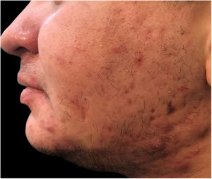 Acne nódulo‐cística em homem trans, desenvolvida três meses após o início da terapia intramuscular com testosterona.