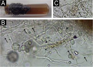 (A) Aspecto enegrecido da colônia. (B) Microscopia óptica – hifas com dilatações (setas); no canto superior direito, observa‐se área acastanhada da colônia, que não foi dissolvida. (C) Microscopia óptica ‐ ascósporo inicial (seta).