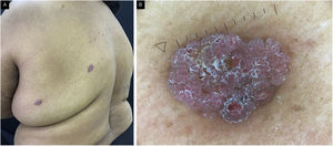 (A) Poromas apócrinos no dorso, aparência clínica. Lesões vegetantes eritematovioláceas, superfície granular e leve projeção. (B) Poroma apócrino, apresentação dermatoscópica.