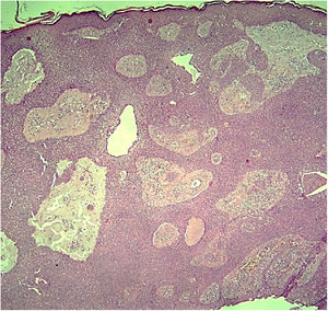 Poroma apócrino: proliferação de células basaloides sem atipias, em traves anastomosadas conectadas à epiderme com formação de lúmens glandulares (Hematoxilina & eosina, 40×).