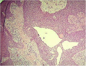 Poroma apócrino: proliferação de células basaloides sem atipias formando lúmens glandulares com projeções papilíferas do revestimento (Hematoxilina & eosina, 100×).