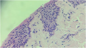 Histopatologia. Proliferação intraepidérmica de queratinócitos atípicos com mitoses abundantes (Hematoxilina & eosina, 400×).