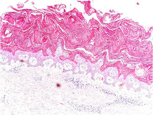 Orto‐hiperceratose, ausência de camada granulosa e acantose de pequeno grau são observadas na epiderme. Na derme superior, há pequeno infiltrado linfocitário perivascular (Hematoxilina & eosina, 40×).