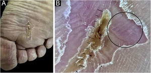 Região plantar direita da paciente, na primeira avaliação no nosso serviço. À esquerda, a foto clínica evidencia a cicatriz cirúrgica da exérese prévia em serviço externo. À direita, a dermatoscopia de contato com luz polarizada da pele adjacente à cicatriz evidencia o “padrão vascular em cristas paralelas” na área circulada em preto.