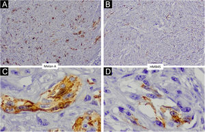 Pelo exame imuno‐histoquímico, comprovou‐se a presença de células melanocíticas atípicas que demonstraram imunoexpressão de Melan A e HMB45 (40×nas fotos superiores e 400×nas fotos inferiores).